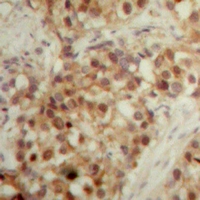 Immunohistochemical analysis of LONP2 staining in human breast cancer formalin fixed paraffin embedded tissue section. The section was pre-treated using heat mediated antigen retrieval with sodium citrate buffer (pH 6.0). The section was then incubated with the antibody at room temperature and detected using an HRP conjugacompact polymer system. DAB was used as the chromogen. The section was then counterstained with haematoxylin and mounted with DPX.