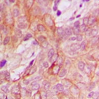 Immunohistochemical analysis of PPM1K staining in human breast cancer formalin fixed paraffin embedded tissue section. The section was pre-treated using heat mediated antigen retrieval with sodium citrate buffer (pH 6.0). The section was then incubated with the antibody at room temperature and detected using an HRP conjugacompact polymer system. DAB was used as the chromogen. The section was then counterstained with haematoxylin and mounted with DPX.