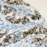 Immunohistochemical analysis of RRS1 staining in human colon cancer formalin fixed paraffin embedded tissue section. The section was pre-treated using heat mediated antigen retrieval with sodium citrate buffer (pH 6.0). The section was then incubated with the antibody at room temperature and detected using an HRP conjugacompact polymer system. DAB was used as the chromogen. The section was then counterstained with haematoxylin and mounted with DPX.