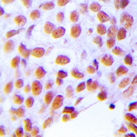 Immunohistochemical analysis of ZNF24 staining in human breast cancer formalin fixed paraffin embedded tissue section. The section was pre-treated using heat mediated antigen retrieval with sodium citrate buffer (pH 6.0). The section was then incubated with the antibody at room temperature and detected using an HRP conjugacompact polymer system. DAB was used as the chromogen. The section was then counterstained with haematoxylin and mounted with DPX.