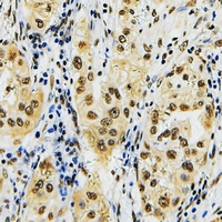 Immunohistochemical analysis of ID4 staining in human lung cancer formalin fixed paraffin embedded tissue section. The section was pre-treated using heat mediated antigen retrieval with sodium citrate buffer (pH 6.0). The section was then incubated with the antibody at room temperature and detected using an HRP conjugacompact polymer system. DAB was used as the chromogen. The section was then counterstained with haematoxylin and mounted with DPX.
