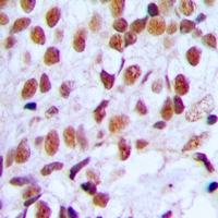 Immunohistochemical analysis of FOXK1 staining in human breast cancer formalin fixed paraffin embedded tissue section. The section was pre-treated using heat mediated antigen retrieval with sodium citrate buffer (pH 6.0). The section was then incubated with the antibody at room temperature and detected using an HRP conjugacompact polymer system. DAB was used as the chromogen. The section was then counterstained with haematoxylin and mounted with DPX.