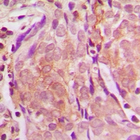 Immunohistochemical analysis of ZNF397 staining in human breast cancer formalin fixed paraffin embedded tissue section. The section was pre-treated using heat mediated antigen retrieval with sodium citrate buffer (pH 6.0). The section was then incubated with the antibody at room temperature and detected using an HRP conjugacompact polymer system. DAB was used as the chromogen. The section was then counterstained with haematoxylin and mounted with DPX.