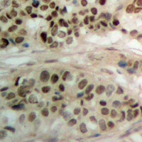 Immunohistochemical analysis of PBOV1 staining in human prostate cancer formalin fixed paraffin embedded tissue section. The section was pre-treated using heat mediated antigen retrieval with sodium citrate buffer (pH 6.0). The section was then incubated with the antibody at room temperature and detected using an HRP conjugacompact polymer system. DAB was used as the chromogen. The section was then counterstained with haematoxylin and mounted with DPX.