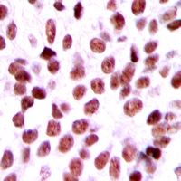 Immunohistochemical analysis of BCA3 staining in human breast cancer formalin fixed paraffin embedded tissue section. The section was pre-treated using heat mediated antigen retrieval with sodium citrate buffer (pH 6.0). The section was then incubated with the antibody at room temperature and detected using an HRP conjugacompact polymer system. DAB was used as the chromogen. The section was then counterstained with haematoxylin and mounted with DPX.
