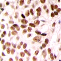 Immunohistochemical analysis of SUR2 staining in human breast cancer formalin fixed paraffin embedded tissue section. The section was pre-treated using heat mediated antigen retrieval with sodium citrate buffer (pH 6.0). The section was then incubated with the antibody at room temperature and detected using an HRP conjugacompact polymer system. DAB was used as the chromogen. The section was then counterstained with haematoxylin and mounted with DPX.