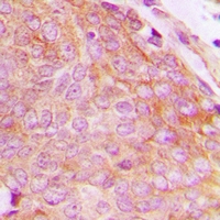 Immunohistochemical analysis of CHKB staining in human breast cancer formalin fixed paraffin embedded tissue section. The section was pre-treated using heat mediated antigen retrieval with sodium citrate buffer (pH 6.0). The section was then incubated with the antibody at room temperature and detected using an HRP conjugacompact polymer system. DAB was used as the chromogen. The section was then counterstained with haematoxylin and mounted with DPX.