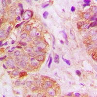 Immunohistochemical analysis of GSPT1 staining in human breast cancer formalin fixed paraffin embedded tissue section. The section was pre-treated using heat mediated antigen retrieval with sodium citrate buffer (pH 6.0). The section was then incubated with the antibody at room temperature and detected using an HRP conjugacompact polymer system. DAB was used as the chromogen. The section was then counterstained with haematoxylin and mounted with DPX.