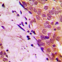 Immunohistochemical analysis of APBB2 staining in human prostate cancer formalin fixed paraffin embedded tissue section. The section was pre-treated using heat mediated antigen retrieval with sodium citrate buffer (pH 6.0). The section was then incubated with the antibody at room temperature and detected using an HRP conjugacompact polymer system. DAB was used as the chromogen. The section was then counterstained with haematoxylin and mounted with DPX.