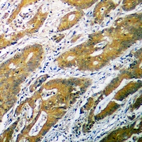 Immunohistochemical analysis of B4GALT1 staining in human colon cancer formalin fixed paraffin embedded tissue section. The section was pre-treated using heat mediated antigen retrieval with sodium citrate buffer (pH 6.0). The section was then incubated with the antibody at room temperature and detected using an HRP conjugacompact polymer system. DAB was used as the chromogen. The section was then counterstained with haematoxylin and mounted with DPX.