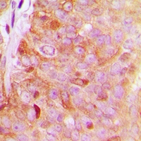 Immunohistochemical analysis of FAM203A staining in human breast cancer formalin fixed paraffin embedded tissue section. The section was pre-treated using heat mediated antigen retrieval with sodium citrate buffer (pH 6.0). The section was then incubated with the antibody at room temperature and detected using an HRP conjugacompact polymer system. DAB was used as the chromogen. The section was then counterstained with haematoxylin and mounted with DPX.