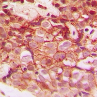 Immunohistochemical analysis of CLIP3 staining in human breast cancer formalin fixed paraffin embedded tissue section. The section was pre-treated using heat mediated antigen retrieval with sodium citrate buffer (pH 6.0). The section was then incubated with the antibody at room temperature and detected using an HRP conjugacompact polymer system. DAB was used as the chromogen. The section was then counterstained with haematoxylin and mounted with DPX.