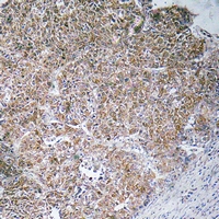 Immunohistochemical analysis of CHST13 staining in human liver cancer formalin fixed paraffin embedded tissue section. The section was pre-treated using heat mediated antigen retrieval with sodium citrate buffer (pH 6.0). The section was then incubated with the antibody at room temperature and detected using an HRP conjugacompact polymer system. DAB was used as the chromogen. The section was then counterstained with haematoxylin and mounted with DPX.