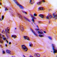 Immunohistochemical analysis of CDC42EP4 staining in human lung cancer formalin fixed paraffin embedded tissue section. The section was pre-treated using heat mediated antigen retrieval with sodium citrate buffer (pH 6.0). The section was then incubated with the antibody at room temperature and detected using an HRP conjugacompact polymer system. DAB was used as the chromogen. The section was then counterstained with haematoxylin and mounted with DPX.