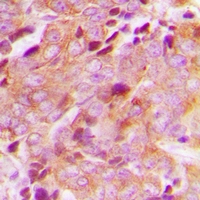 Immunohistochemical analysis of CEP76 staining in human breast cancer formalin fixed paraffin embedded tissue section. The section was pre-treated using heat mediated antigen retrieval with sodium citrate buffer (pH 6.0). The section was then incubated with the antibody at room temperature and detected using an HRP conjugacompact polymer system. DAB was used as the chromogen. The section was then counterstained with haematoxylin and mounted with DPX.