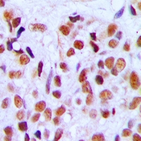 Immunohistochemical analysis of RRP8 staining in human breast cancer formalin fixed paraffin embedded tissue section. The section was pre-treated using heat mediated antigen retrieval with sodium citrate buffer (pH 6.0). The section was then incubated with the antibody at room temperature and detected using an HRP conjugacompact polymer system. DAB was used as the chromogen. The section was then counterstained with haematoxylin and mounted with DPX.