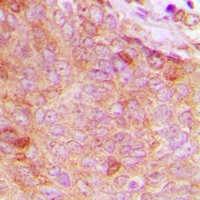 Immunohistochemical analysis of Copine 8 staining in human breast cancer formalin fixed paraffin embedded tissue section. The section was pre-treated using heat mediated antigen retrieval with sodium citrate buffer (pH 6.0). The section was then incubated with the antibody at room temperature and detected using an HRP conjugacompact polymer system. DAB was used as the chromogen. The section was then counterstained with haematoxylin and mounted with DPX.