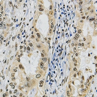 Immunohistochemical analysis of POLR3A staining in human lung cancer formalin fixed paraffin embedded tissue section. The section was pre-treated using heat mediated antigen retrieval with sodium citrate buffer (pH 6.0). The section was then incubated with the antibody at room temperature and detected using an HRP conjugacompact polymer system. DAB was used as the chromogen. The section was then counterstained with haematoxylin and mounted with DPX.