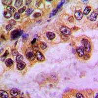 Immunohistochemical analysis of GABRD staining in human lung cancer formalin fixed paraffin embedded tissue section. The section was pre-treated using heat mediated antigen retrieval with sodium citrate buffer (pH 6.0). The section was then incubated with the antibody at room temperature and detected using an HRP conjugacompact polymer system. DAB was used as the chromogen. The section was then counterstained with haematoxylin and mounted with DPX.