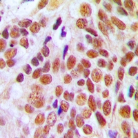 Immunohistochemical analysis of NUMA staining in human breast cancer formalin fixed paraffin embedded tissue section. The section was pre-treated using heat mediated antigen retrieval with sodium citrate buffer (pH 6.0). The section was then incubated with the antibody at room temperature and detected using an HRP conjugacompact polymer system. DAB was used as the chromogen. The section was then counterstained with haematoxylin and mounted with DPX.