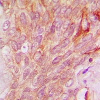 Immunohistochemical analysis of QSK staining in human breast cancer formalin fixed paraffin embedded tissue section. The section was pre-treated using heat mediated antigen retrieval with sodium citrate buffer (pH 6.0). The section was then incubated with the antibody at room temperature and detected using an HRP conjugacompact polymer system. DAB was used as the chromogen. The section was then counterstained with haematoxylin and mounted with DPX.