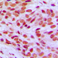 Immunohistochemical analysis of FLI1 staining in human breast cancer formalin fixed paraffin embedded tissue section. The section was pre-treated using heat mediated antigen retrieval with sodium citrate buffer (pH 6.0). The section was then incubated with the antibody at room temperature and detected using an HRP conjugated compact polymer system. DAB was used as the chromogen. The section was then counterstained with haematoxylin and mounted with DPX.