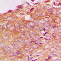 Immunohistochemical analysis of SPTBN1 staining in human breast cancer formalin fixed paraffin embedded tissue section. The section was pre-treated using heat mediated antigen retrieval with sodium citrate buffer (pH 6.0). The section was then incubated with the antibody at room temperature and detected using an HRP conjugacompact polymer system. DAB was used as the chromogen. The section was then counterstained with haematoxylin and mounted with DPX.