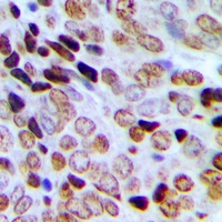 Immunohistochemical analysis of SRSF8 staining in human prostate cancer formalin fixed paraffin embedded tissue section. The section was pre-treated using heat mediated antigen retrieval with sodium citrate buffer (pH 6.0). The section was then incubated with the antibody at room temperature and detected using an HRP conjugacompact polymer system. DAB was used as the chromogen. The section was then counterstained with haematoxylin and mounted with DPX.
