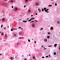 Immunohistochemical analysis of TIGD3 staining in human liver cancer formalin fixed paraffin embedded tissue section. The section was pre-treated using heat mediated antigen retrieval with sodium citrate buffer (pH 6.0). The section was then incubated with the antibody at room temperature and detected using an HRP conjugacompact polymer system. AEC was used as the chromogen. The section was then counterstained with haematoxylin and mounted with DPX.