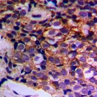 Immunohistochemical analysis of MTIF3 staining in human prostate cancer formalin fixed paraffin embedded tissue section. The section was pre-treated using heat mediated antigen retrieval with sodium citrate buffer (pH 6.0). The section was then incubated with the antibody at room temperature and detected using an HRP conjugacompact polymer system. DAB was used as the chromogen. The section was then counterstained with haematoxylin and mounted with DPX.