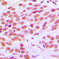 Immunohistochemical analysis of FRA2 staining in human breast cancer formalin fixed paraffin embedded tissue section. The section was pre-treated using heat mediated antigen retrieval with sodium citrate buffer (pH 6.0). The section was then incubated with the antibody at room temperature and detected using an HRP conjugated compact polymer system. DAB was used as the chromogen. The section was then counterstained with haematoxylin and mounted with DPX.