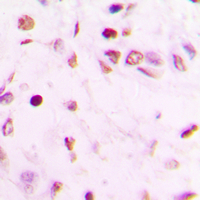 Immunohistochemical analysis of GATA4 staining in human lung cancer formalin fixed paraffin embedded tissue section. The section was pre-treated using heat mediated antigen retrieval with sodium citrate buffer (pH 6.0). The section was then incubated with the antibody at room temperature and detected using an HRP conjugated compact polymer system. DAB was used as the chromogen. The section was then counterstained with haematoxylin and mounted with DPX.