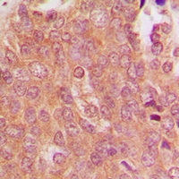 Immunohistochemical analysis of MID1 staining in human breast cancer formalin fixed paraffin embedded tissue section. The section was pre-treated using heat mediated antigen retrieval with sodium citrate buffer (pH 6.0). The section was then incubated with the antibody at room temperature and detected using an HRP conjugacompact polymer system. DAB was used as the chromogen. The section was then counterstained with haematoxylin and mounted with DPX.