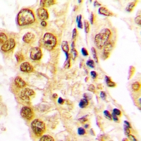 Immunohistochemical analysis of JUND staining in human lung cancer formalin fixed paraffin embedded tissue section. The section was pre-treated using heat mediated antigen retrieval with sodium citrate buffer (pH 6.0). The section was then incubated with the antibody at room temperature and detected using an HRP conjugacompact polymer system. DAB was used as the chromogen. The section was then counterstained with haematoxylin and mounted with DPX.