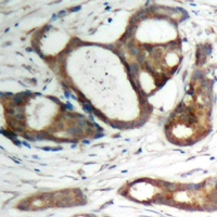 Immunohistochemical analysis of Plakophilin 2 staining in human prostate cancer formalin fixed paraffin embedded tissue section. The section was pre-treated using heat mediated antigen retrieval with sodium citrate buffer (pH 6.0). The section was then incubated with the antibody at room temperature and detected using an HRP conjugacompact polymer system. DAB was used as the chromogen. The section was then counterstained with haematoxylin and mounted with DPX.