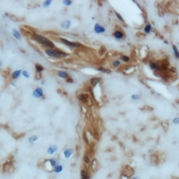 Immunohistochemical analysis of MENA staining in human prostate cancer formalin fixed paraffin embedded tissue section. The section was pre-treated using heat mediated antigen retrieval with sodium citrate buffer (pH 6.0). The section was then incubated with the antibody at room temperature and detected using an HRP conjugacompact polymer system. DAB was used as the chromogen. The section was then counterstained with haematoxylin and mounted with DPX.