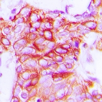 Immunohistochemical analysis of GPR101 staining in human breast cancer formalin fixed paraffin embedded tissue section. The section was pre-treated using heat mediated antigen retrieval with sodium citrate buffer (pH 6.0). The section was then incubated with the antibody at room temperature and detected using an HRP conjugacompact polymer system. DAB was used as the chromogen. The section was then counterstained with haematoxylin and mounted with DPX.