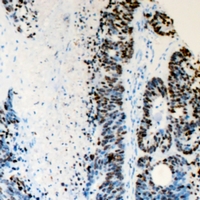 Immunohistochemical analysis of FANCD2 staining in human colon cancer formalin fixed paraffin embedded tissue section. The section was pre-treated using heat mediated antigen retrieval with sodium citrate buffer (pH 6.0). The section was then incubated with the antibody at room temperature and detected using an HRP conjugacompact polymer system. DAB was used as the chromogen. The section was then counterstained with haematoxylin and mounted with DPX.