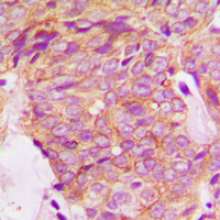 Immunohistochemical analysis of GRB14 staining in human breast cancer formalin fixed paraffin embedded tissue section. The section was pre-treated using heat mediated antigen retrieval with sodium citrate buffer (pH 6.0). The section was then incubated with the antibody at room temperature and detected using an HRP conjugated compact polymer system. DAB was used as the chromogen. The section was then counterstained with haematoxylin and mounted with DPX.