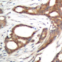 Immunohistochemical analysis of PER2 (pS662) staining in human prostate cancer formalin fixed paraffin embedded tissue section. The section was pre-treated using heat mediated antigen retrieval with sodium citrate buffer (pH 6.0). The section was then incubated with the antibody at room temperature and detected using an HRP conjugacompact polymer system. DAB was used as the chromogen. The section was then counterstained with haematoxylin and mounted with DPX.