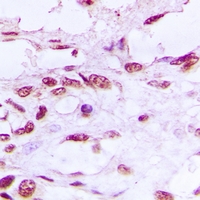 Immunohistochemical analysis of DNA Ligase 4 staining in human prostate cancer formalin fixed paraffin embedded tissue section. The section was pre-treated using heat mediated antigen retrieval with sodium citrate buffer (pH 6.0). The section was then incubated with the antibody at room temperature and detected using an HRP conjugacompact polymer system. DAB was used as the chromogen. The section was then counterstained with haematoxylin and mounted with DPX.