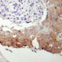 Immunohistochemical analysis of cGK 2 staining in human prostate cancer formalin fixed paraffin embedded tissue section. The section was pre-treated using heat mediated antigen retrieval with sodium citrate buffer (pH 6.0). The section was then incubated with the antibody at room temperature and detected using an HRP conjugacompact polymer system. DAB was used as the chromogen. The section was then counterstained with haematoxylin and mounted with DPX.
