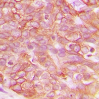 Immunohistochemical analysis of Claudin 3 staining in human breast cancer formalin fixed paraffin embedded tissue section. The section was pre-treated using heat mediated antigen retrieval with sodium citrate buffer (pH 6.0). The section was then incubated with the antibody at room temperature and detected using an HRP conjugacompact polymer system. DAB was used as the chromogen. The section was then counterstained with haematoxylin and mounted with DPX.