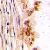 Immunohistochemical analysis of hnRNP M staining in human lung cancer formalin fixed paraffin embedded tissue section. The section was pre-treated using heat mediated antigen retrieval with sodium citrate buffer (pH 6.0). The section was then incubated with the antibody at room temperature and detected using an HRP conjugacompact polymer system. DAB was used as the chromogen. The section was then counterstained with haematoxylin and mounted with DPX.