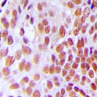 Immunohistochemical analysis of GTF3C2 staining in human breast cancer formalin fixed paraffin embedded tissue section. The section was pre-treated using heat mediated antigen retrieval with sodium citrate buffer (pH 6.0). The section was then incubated with the antibody at room temperature and detected using an HRP conjugacompact polymer system. DAB was used as the chromogen. The section was then counterstained with haematoxylin and mounted with DPX.