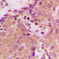 Immunohistochemical analysis of B3GALTL staining in human breast cancer formalin fixed paraffin embedded tissue section. The section was pre-treated using heat mediated antigen retrieval with sodium citrate buffer (pH 6.0). The section was then incubated with the antibody at room temperature and detected using an HRP conjugacompact polymer system. DAB was used as the chromogen. The section was then counterstained with haematoxylin and mounted with DPX.