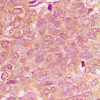Immunohistochemical analysis of NBEAL1 staining in human breast cancer formalin fixed paraffin embedded tissue section. The section was pre-treated using heat mediated antigen retrieval with sodium citrate buffer (pH 6.0). The section was then incubated with the antibody at room temperature and detected using an HRP conjugacompact polymer system. DAB was used as the chromogen. The section was then counterstained with haematoxylin and mounted with DPX.