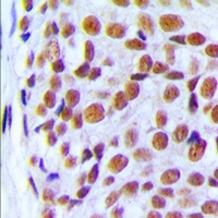 Immunohistochemical analysis of PRPF6 staining in human breast cancer formalin fixed paraffin embedded tissue section. The section was pre-treated using heat mediated antigen retrieval with sodium citrate buffer (pH 6.0). The section was then incubated with the antibody at room temperature and detected using an HRP conjugacompact polymer system. DAB was used as the chromogen. The section was then counterstained with haematoxylin and mounted with DPX.