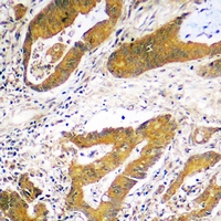 Immunohistochemical analysis of USP48 staining in human colon cancer formalin fixed paraffin embedded tissue section. The section was pre-treated using heat mediated antigen retrieval with sodium citrate buffer (pH 6.0). The section was then incubated with the antibody at room temperature and detected using an HRP conjugacompact polymer system. DAB was used as the chromogen. The section was then counterstained with haematoxylin and mounted with DPX.