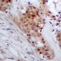 Immunohistochemical analysis of TP53INP2 staining in human breast cancer formalin fixed paraffin embedded tissue section. The section was pre-treated using heat mediated antigen retrieval with sodium citrate buffer (pH 6.0). The section was then incubated with the antibody at room temperature and detected using an HRP conjugacompact polymer system. DAB was used as the chromogen. The section was then counterstained with haematoxylin and mounted with DPX.